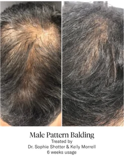 Advanced Hair System Kit Tratamiento de Regeneración Capilar