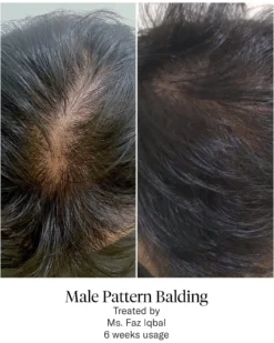 Advanced Hair System Kit Tratamiento de Regeneración Capilar