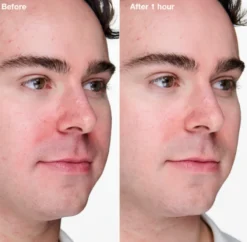 Anti-Blemish Solutions Clinical Gel Avanzado Anti-Imperfecciones