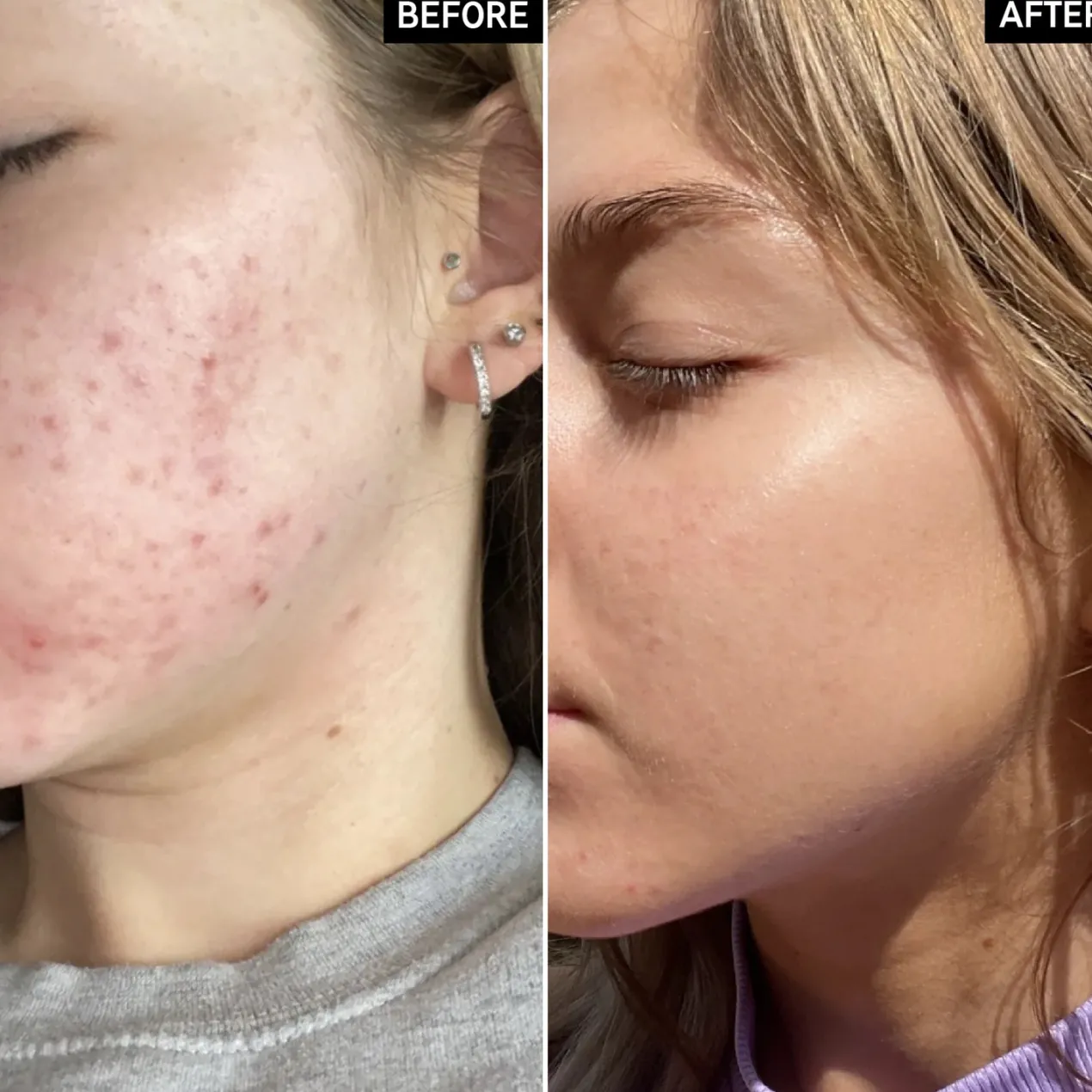 Beta Hydroxy Acid Serum