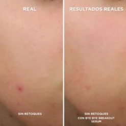 Bye Bye Breakout Serum Antiacné