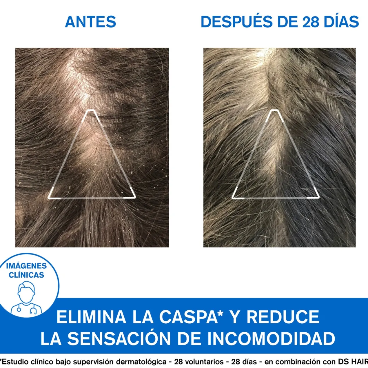 DS Hair Champú Anticaspa
