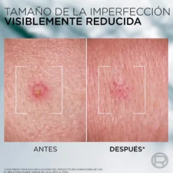 Men Expert Derma Control S.O.S Pimple Paste Solución Anti-imperfecciones con Niacinamida y Ácido Glicólico