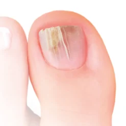 Pincel Anti Hongos de las Uñas