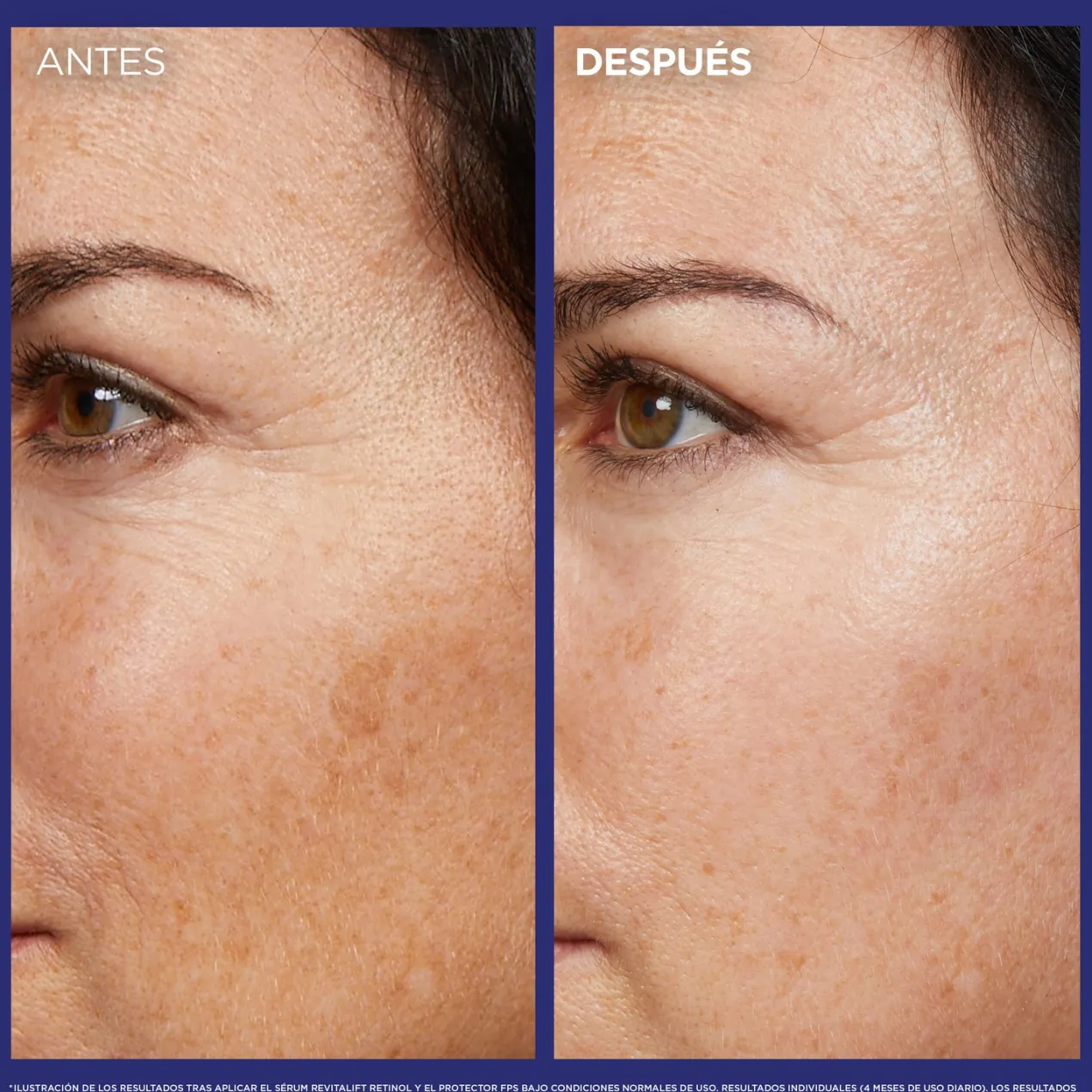 Revitalift Laser serum de noche retinol puro arrugas profundas