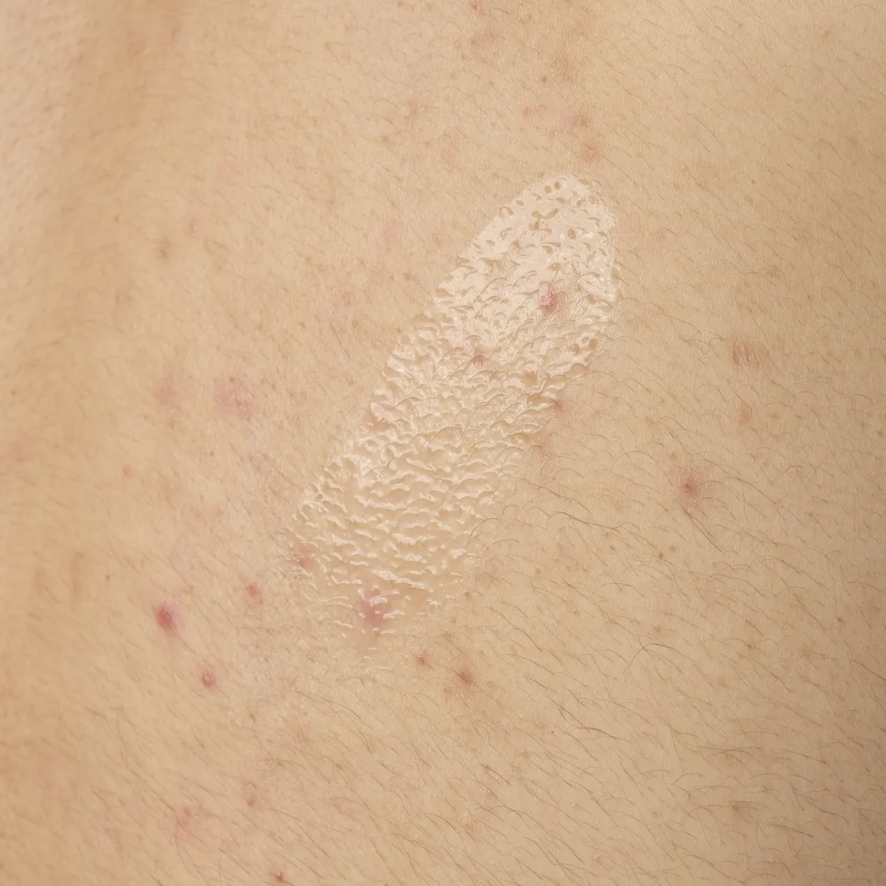 Salicylic Acid 0.5% Body Serum Anti Imperfecciones